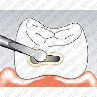 Sonicflex bevel 58 A  насадка для минимально инвазивной терапии кариеса с алмазным покрытием, мезиальная